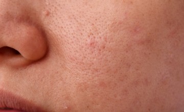 Gözenek (Skin Pores /Comedogenic)